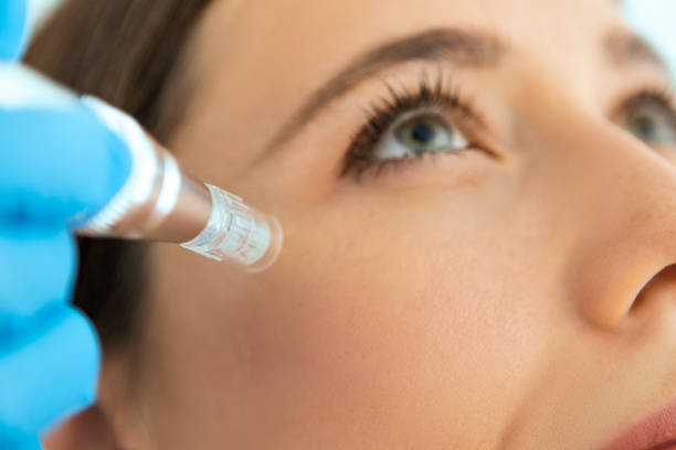 RF Microneedling